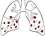 Lung Affected By Bronchial Pneumonia